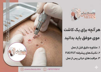 هر آنچه برای یک کاشت موی موفق باید بدانید